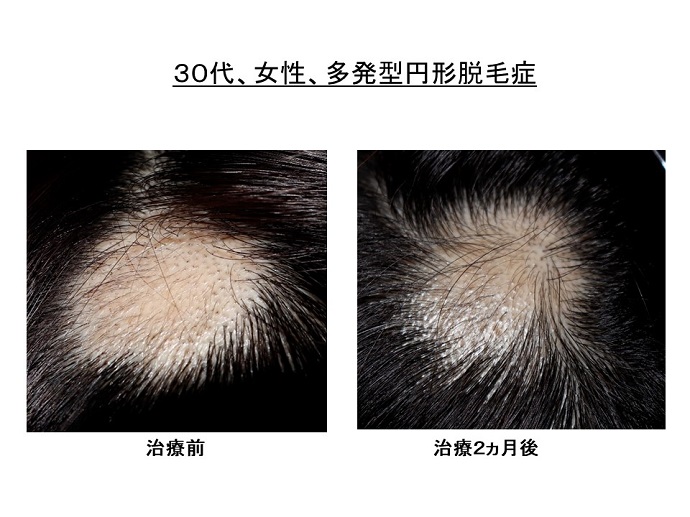 円形脱毛症　病院